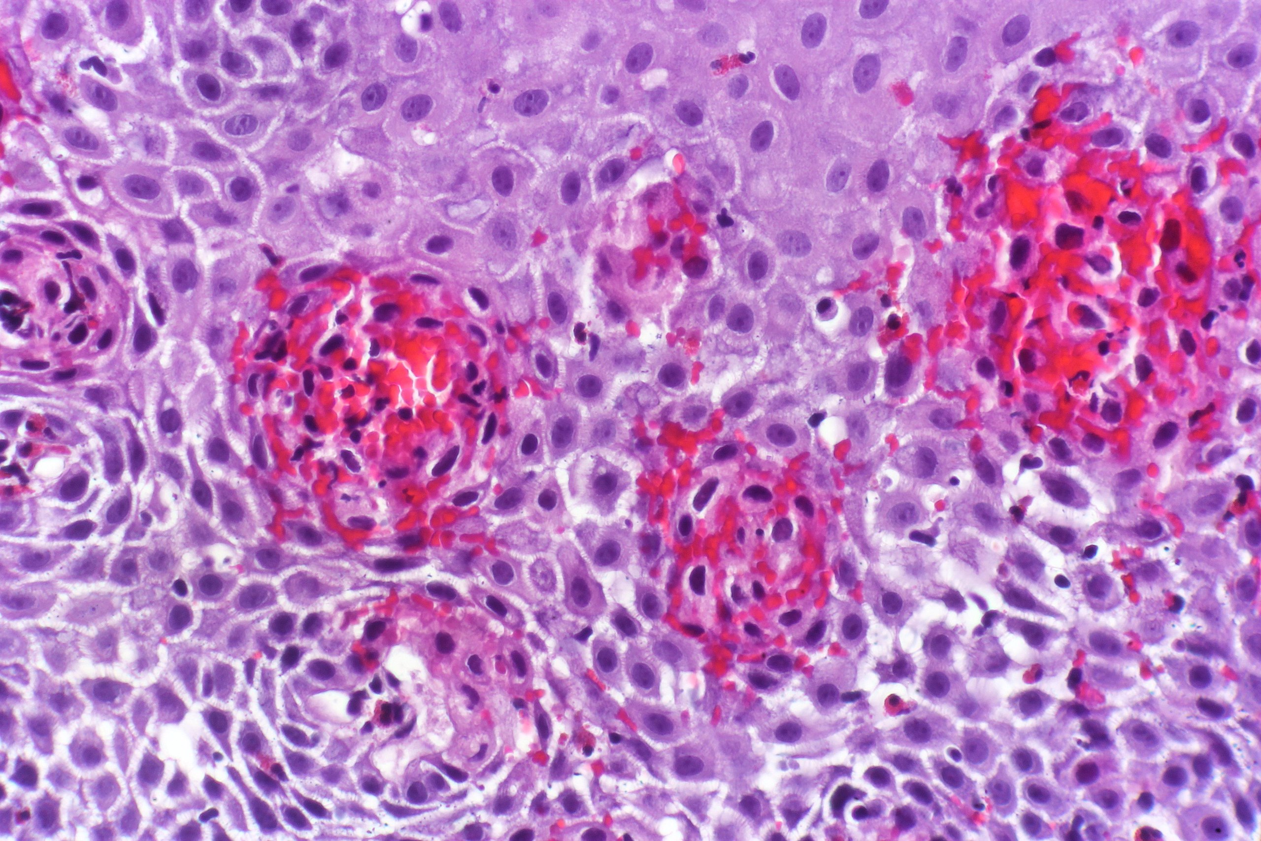 Eosinophile Ösophagitis
Eosinophilenvermehrung sowie eosinophile Mikroabszesse